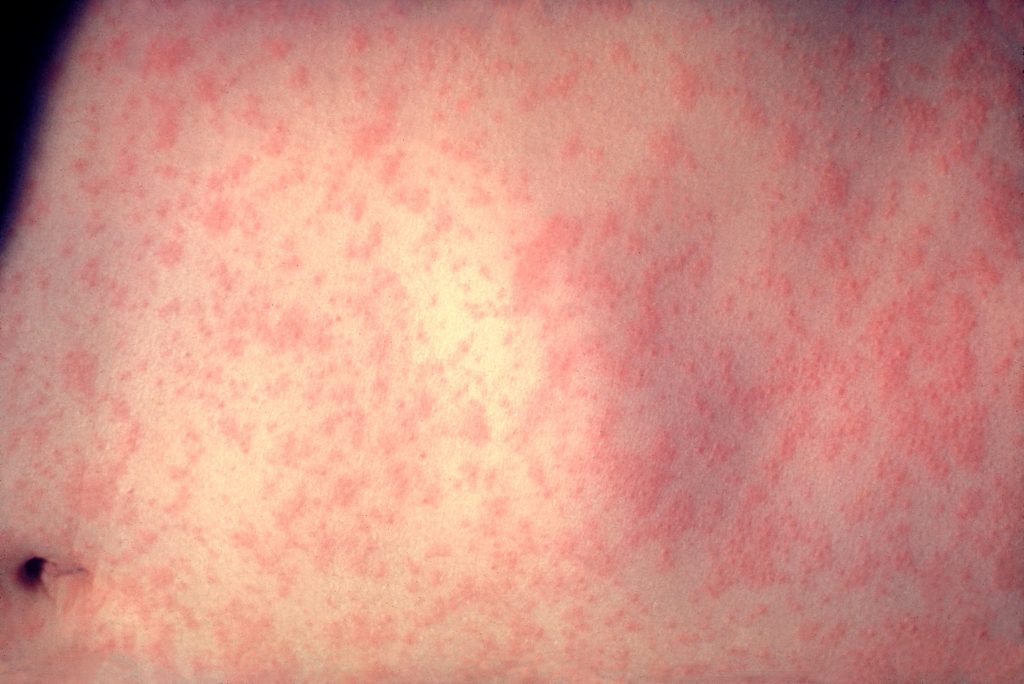 Morbillivirus_measles_infection - Alcaldes Regios Sarampión En Nuevo León Sube 80% En Una Semana Y Crecen Los Contagios, Mientras Samuel Y Mariana Destinan Hasta 139 Mil Pesos Diarios a Su Publicidad.